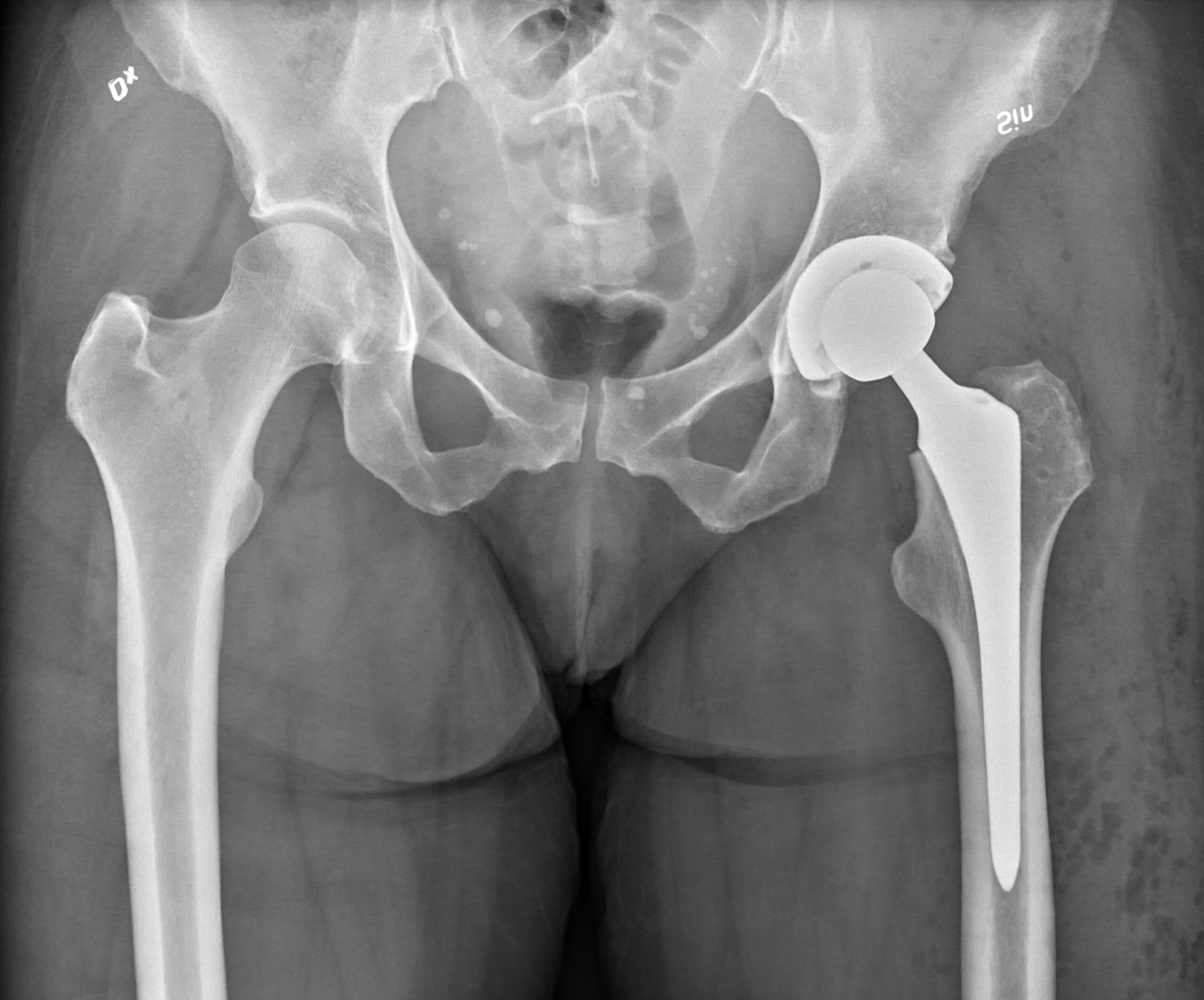 Hip Prosthesis